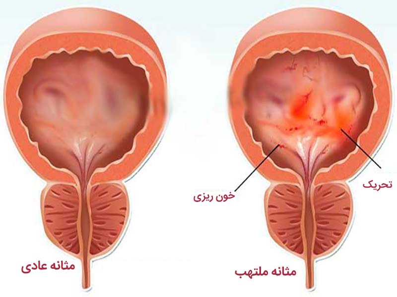  عفونت ادراری زنان 